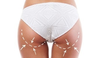 Woman in white panties with arrows on her legs. Cellulite removal concept.