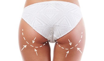 Woman in white panties with arrows on her legs. Cellulite remova