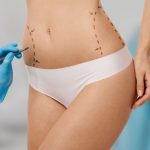 Liposuccion - Dr Garcia - Paris