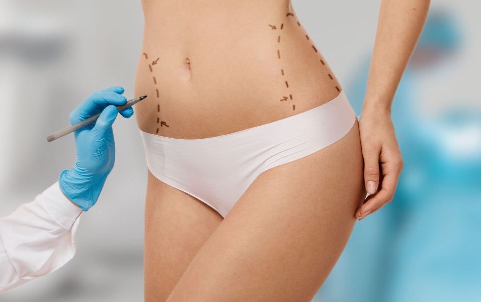 Liposuccion - Dr Garcia - Paris